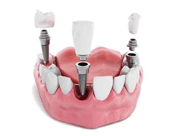 Dental Implants Mission, TX